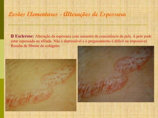 Lesões Elementares - Alterações de Espessura
Ω Esclerose: Alteração da espessura com aumento da consistência da pele. A pele pode
estar espessada ou afilada. Não é depressível e o pregueamento é difícil ou impossível.
Resulta de fibrose do colágeno.

 