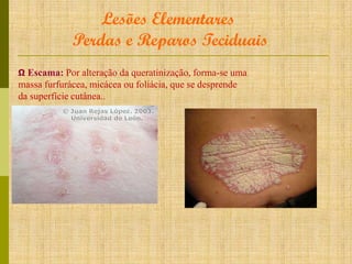 Lesões Elementares
Perdas e Reparos Teciduais
Ω Escama: Por alteração da queratinização, forma-se uma

massa furfurácea, micácea ou foliácia, que se desprende
da superfície cutânea..

 