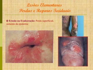 Lesões Elementares
Perdas e Reparos Teciduais
Ω Erosão ou Exulceração: Perda superficial,

somente da epiderme

 