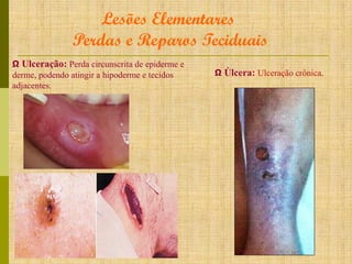 Lesões Elementares
Perdas e Reparos Teciduais
Ω Ulceração: Perda circunscrita de epiderme e
derme, podendo atingir a hipoderme e tecidos
adjacentes.

Ω Úlcera: Ulceração crônica.

 