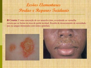 Lesões Elementares
Perdas e Reparos Teciduais
Ω Crosta: É uma concreção de cor amarelo-clara, esverdeada ou vermelha
escura que se forma em área de perda tecidual. Resulta de dessecamento de serosidade,
pus ou sangue misturados com restos epiteliais.

 