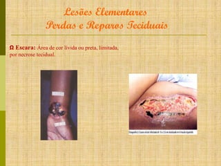 Lesões Elementares
Perdas e Reparos Teciduais
Ω Escara: Área de cor lívida ou preta, limitada,
por necrose tecidual.

 