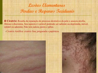 Lesões Elementares
Perdas e Reparos Teciduais
Ω Cicatriz: Resulta da reparação de processo destrutivo da pele e associa atrofia,
fibrose e discromia. Seu aspecto é variável podendo ser saliente ou deprimida, móvel,
retrátil ou aderente. Não tem sulcos, poros e pêlos.
- Cicatriz Atrófica: cicatriz fina, pregueada e papirácea.

 