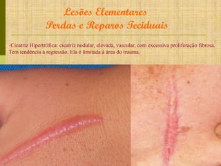 Lesões Elementares
Perdas e Reparos Teciduais
-Cicatriz Hipertrófica: cicatriz nodular, elevada, vascular, com excessiva proliferação fibrosa.
Tem tendência à regressão. Ela é limitada à área do trauma.

 