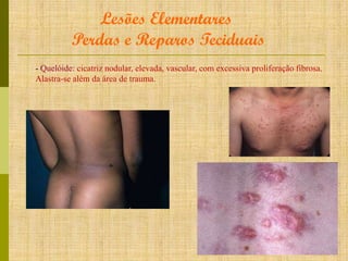 Lesões Elementares
Perdas e Reparos Teciduais
- Quelóide: cicatriz nodular, elevada, vascular, com excessiva proliferação fibrosa.
Alastra-se além da área de trauma.

 