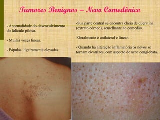 Tumores Benignos – Nevo Comedônico
- Anormalidade do desenvolvimento
do folículo piloso.
- Muitas vezes linear.
- Pápulas, ligeiramente elevadas.

-Sua parte central se encontra cheia de queratina
(extrato córneo), semelhante ao comedão.

-Geralmente é unilateral e linear.
- Quando há alteração inflamatória os nevos se
tornam cicatrizes, com aspecto de acne conglobata.

 