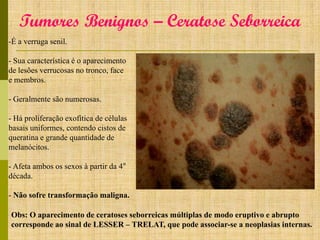 Tumores Benignos – Ceratose Seborreica
-É a verruga senil.
- Sua característica é o aparecimento
de lesões verrucosas no tronco, face
e membros.
- Geralmente são numerosas.
- Há proliferação exofítica de células
basais uniformes, contendo cistos de
queratina e grande quantidade de
melanócitos.
- Afeta ambos os sexos à partir da 4°
década.
- Não sofre transformação maligna.
Obs: O aparecimento de ceratoses seborreicas múltiplas de modo eruptivo e abrupto
corresponde ao sinal de LESSER – TRELAT, que pode associar-se a neoplasias internas.

 