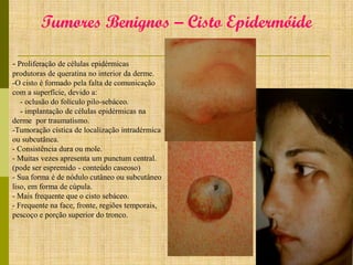 Tumores Benignos – Cisto Epidermóide
- Proliferação de células epidérmicas
produtoras de queratina no interior da derme.
-O cisto é formado pela falta de comunicação
com a superfície, devido a:
- oclusão do folículo pilo-sebáceo.
- implantação de células epidérmicas na
derme por traumatismo.
-Tumoração cística de localização intradérmica
ou subcutânea.
- Consistência dura ou mole.
- Muitas vezes apresenta um punctum central.
(pode ser espremido - conteúdo caseoso)
- Sua forma é de nódulo cutâneo ou subcutâneo
liso, em forma de cúpula.
- Mais frequente que o cisto sebáceo.
- Frequente na face, fronte, regiões temporais,
pescoço e porção superior do tronco.

 