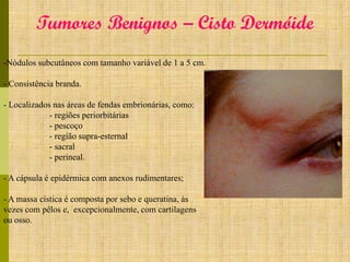 Tumores Benignos – Cisto Dermóide
-Nódulos subcutâneos com tamanho variável de 1 a 5 cm.

- Consistência branda.
- Localizados nas áreas de fendas embrionárias, como:
- regiões periorbitárias
- pescoço
- região supra-esternal
- sacral
- perineal.
- A cápsula é epidérmica com anexos rudimentares;
- A massa cística é composta por sebo e queratina, às
vezes com pêlos e, excepcionalmente, com cartilagens
ou osso.

 