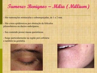 Tumores Benignos – Mília (Millium)
- São tumorações minúsculas e esbranquiçadas, de 1 a 2 mm.

- São cistos epidérmicos por obstrução de folículos
pilossebáceos ou ductos sudoríparos.
- Seu conteúdo possui massa queratinosa.

- Surge particularmente na região peri-orbitária
e também na genitália.

 