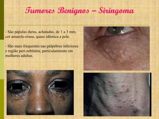 Tumores Benignos – Siringoma
- São pápulas duras, achatadas, de 1 a 3 mm,
cor amarelo-rósea, quase idêntica a pele.
- São mais frequentes nas pálpebras inferiores
e região peri-orbitária; particularmente em
mulheres adultas.

 