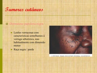 Tumores cutâneos


Dermatose papulosa nigra




Lesões verrucosas com
características semelhantes à
verruga seborreica, mas
habitualmente com dimensão
menor
Raça negra / parda

 