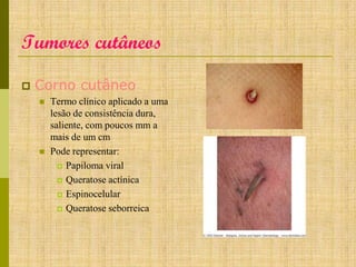 Tumores cutâneos


Corno cutâneo




Termo clínico aplicado a uma
lesão de consistência dura,
saliente, com poucos mm a
mais de um cm
Pode representar:
 Papiloma viral
 Queratose actínica
 Espinocelular
 Queratose seborreica

 