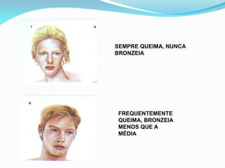 SEMPRE QUEIMA, NUNCA
BRONZEIA
FREQUENTEMENTE
QUEIMA, BRONZEIA
MENOS QUE A
MÉDIA
 