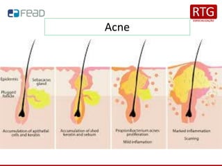 Acne
 