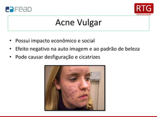 Acne Vulgar
• Possui impacto econômico e social
• Efeito negativo na auto imagem e ao padrão de beleza
• Pode causar desfiguração e cicatrizes
 