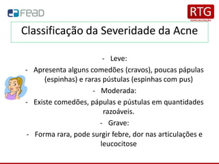 Classificação da Severidade da Acne
- Leve:
- Apresenta alguns comedões (cravos), poucas pápulas
(espinhas) e raras pústulas (espinhas com pus)
- Moderada:
- Existe comedões, pápulas e pústulas em quantidades
razoáveis.
- Grave:
- Forma rara, pode surgir febre, dor nas articulações e
leucocitose
 