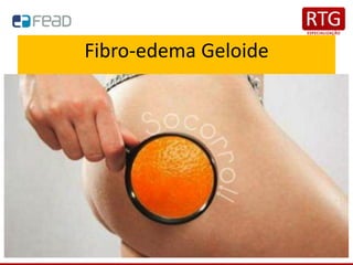 Fibro-edema Geloide
 
