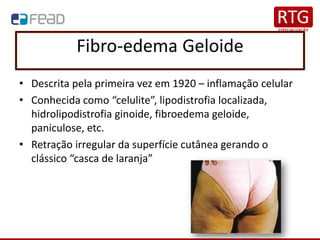 Fibro-edema Geloide
• Descrita pela primeira vez em 1920 – inflamação celular
• Conhecida como “celulite”, lipodistrofia localizada,
hidrolipodistrofia ginoide, fibroedema geloide,
paniculose, etc.
• Retração irregular da superfície cutânea gerando o
clássico “casca de laranja”
 
