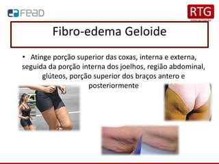 Fibro-edema Geloide
• Atinge porção superior das coxas, interna e externa,
seguida da porção interna dos joelhos, região abdominal,
glúteos, porção superior dos braços antero e
posteriormente
 