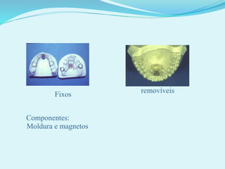 Fixos
removíveis
Componentes:
Moldura e magnetos
 