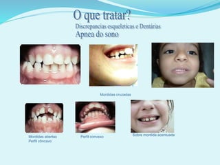 Mordidas cruzadas
Mordidas abertas
Perfil côncavo
Perfil convexo Sobre mordida acentuada
 