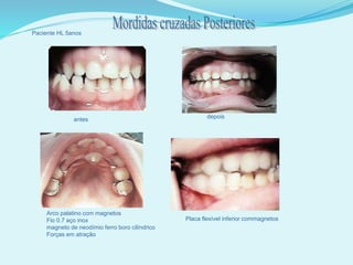 Paciente HL 5anos
antes depois
Arco palatino com magnetos
Fio 0.7 aço inox
magneto de neodímio ferro boro cilíndrico
Forças em atração
Placa flexível inferior commagnetos
 