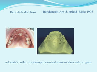 A densidade do fluxo em pontos predeterminados nos modelos é dada em gauss
Densidade do Fluxo BondemarK Am .J. orthod -Maio 1995
7.5
2816
3
3
33
35
22
35
40
35
8
2
7
1.5
0.5
0.5
18
6
1.5
 