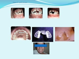 Classe III- perfil côncavo
 