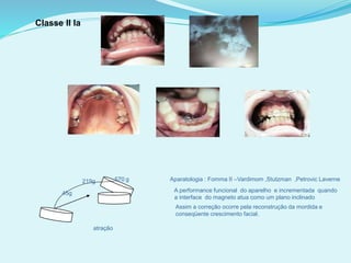 Classe II Ia
45g
219g 570
atração
g Aparatologia : Fomma II –Vardimom ,Stutzman ,Petrovic Laverne
A performance funcional do aparelho e incrementada quando
a interface do magneto atua como um plano inclinado
Assim a correção ocorre pela reconstrução da mordida e
conseqüente crescimento facial.
 