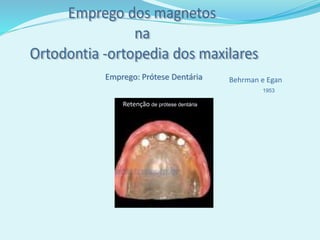 Behrman e EganEmprego: Prótese Dentária
Retenção de prótese dentária
1953
 