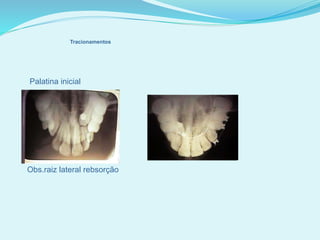 Palatina inicial
Obs.raiz lateral rebsorção
Tracionamentos
 