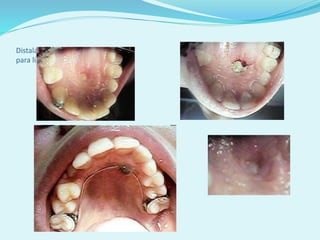 Distalamento do canino
para liberar lateral
 