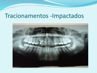 Tracionamentos -Impactados
 