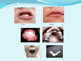 Paciente I 10 anos Ausência de feixe muscular
Antes Depois
 