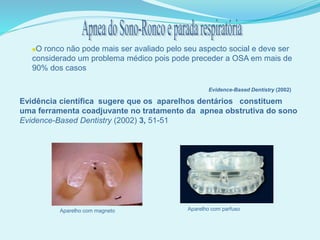 O ronco não pode mais ser avaliado pelo seu aspecto social e deve ser
considerado um problema médico pois pode preceder a OSA em mais de
90% dos casos
Evidence-Based Dentistry (2002)
Evidência científica sugere que os aparelhos dentários constituem
uma ferramenta coadjuvante no tratamento da apnea obstrutiva do sono
Evidence-Based Dentistry (2002) 3, 51-51
Aparelho com magneto Aparelho com parfuso
 