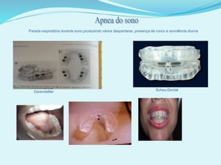 Parada respiratória durante sono,produzindo vários despertares ,presença de ronco e sonolência diurna
Darendeliler Scheu-Dental
 