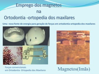 Magnetos(Imãs)Forças convencionais
em Ortodontia -Ortopedia dos Maxilares
Uma nova fonte de energia para geração de forças em ortodontia-ortopedia dos maxilares
 