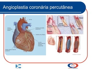 Angioplastia coronária percutânea

 