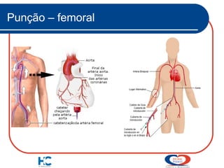 Punção – femoral

 