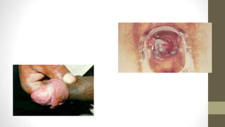 Onicomicose - unha fungo -conhecidas popularmente
como unheiros.
É uma infecção fungícada unha.
Causada por dermatófitos...