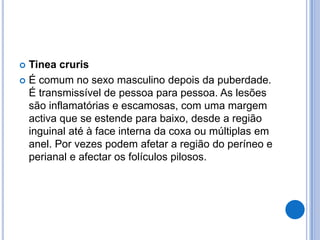  Tinea cruris
 É comum no sexo masculino depois da puberdade.
É transmissível de pessoa para pessoa. As lesões
são inflamatórias e escamosas, com uma margem
activa que se estende para baixo, desde a região
inguinal até à face interna da coxa ou múltiplas em
anel. Por vezes podem afetar a região do períneo e
perianal e afectar os folículos pilosos.
 