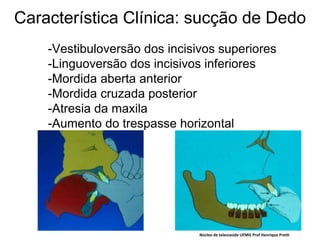 Característica Clínica: sucção de Dedo
-Vestibuloversão dos incisivos superiores
-Linguoversão dos incisivos inferiores
-Mordida aberta anterior
-Mordida cruzada posterior
-Atresia da maxila
-Aumento do trespasse horizontal
Núcleo de telessaúde UFMG Prof Henrique Pretti
 
