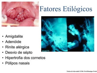 Fatores Etilógicos
• Amigdalite
• Adenóide
• Rinite alérgica
• Desvio de sépto
• Hipertrofia dos cornetos
• Pólipos nasais
 
