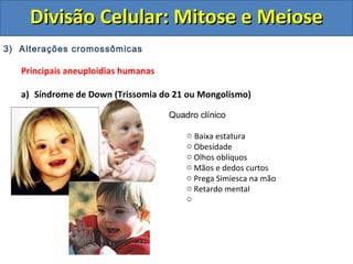 3) Alterações cromossômicas
Principais aneuploidias humanas
a) Síndrome de Down (Trissomia do 21 ou Mongolismo)
Quadro clínico
o Baixa estatura
o Obesidade
o Olhos oblíquos
o Mãos e dedos curtos
o Prega Simiesca na mão
o Retardo mental
o
Divisão Celular: Mitose e MeioseDivisão Celular: Mitose e Meiose
 