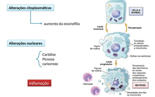 Alterações citoplasmáticas
aumento da eosinofilia
Alterações nucleares
Cariólise
Picnose
cariorrexe
Inflamação
 