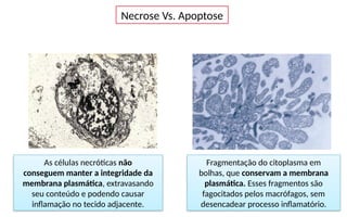 Necrose Vs. Apoptose
Fragmentação do citoplasma em
bolhas, que conservam a membrana
plasmática. Esses fragmentos são
fagocitados pelos macrófagos, sem
desencadear processo inflamatório.
As células necróticas não
conseguem manter a integridade da
membrana plasmática, extravasando
seu conteúdo e podendo causar
inflamação no tecido adjacente.
 