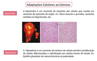 Adaptações Celulares ao Estresse
Hipertrofia
A hipertrofia é um aumento do tamanho das células que resulta em
aumento do tamanho do órgão. Ex: Útero durante a gravidez, aumento
cardíaco na hipertensão, etc.
Hiperplasia
A hiperplasia é um aumento do número de células devido à proliferação
de células diferenciadas e substituição por células-tronco do tecido. Ex:
Epitélio glandular da mama feminina na puberdade.
 