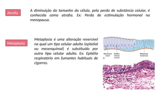Atrofia
A diminuição do tamanho da célula, pela perda de substância celular, é
conhecida como atrofia. Ex: Perda de estimulação hormonal na
menopausa.
Metaplasia
Metaplasia é uma alteração reversível
na qual um tipo celular adulto (epitelial
ou mesenquimal) é substituído por
outro tipo celular adulto. Ex: Epitélio
respiratório em fumantes habituais de
cigarros.
 