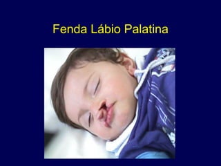 Fenda Lábio Palatina
 